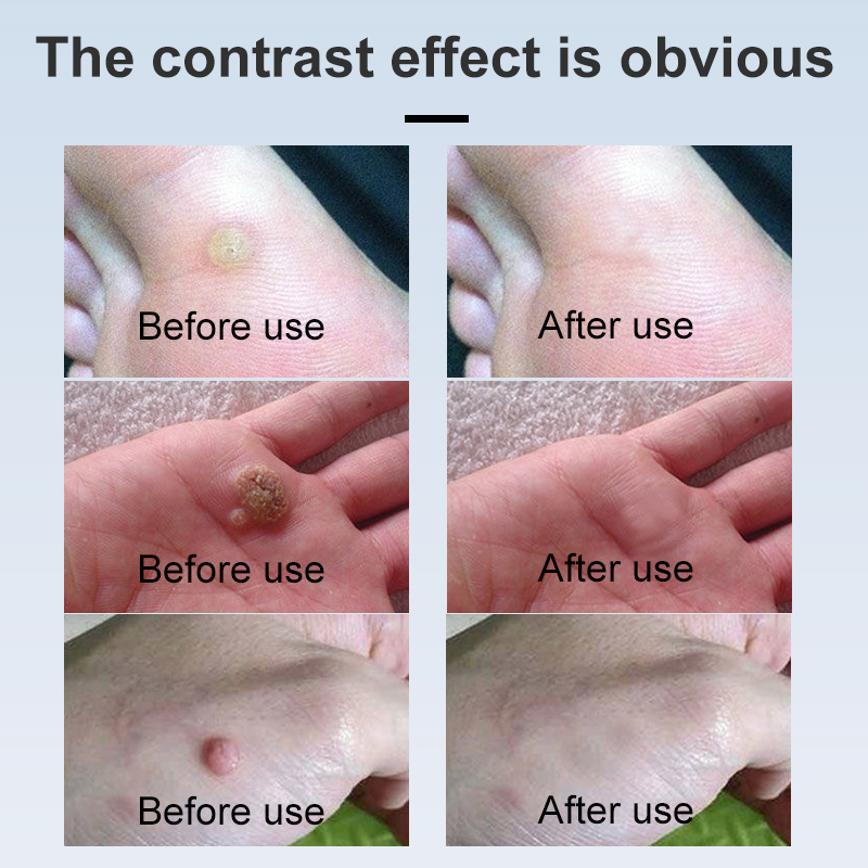 Plantar Wart Corn Freeze Off Fast-Acting Wart Remover Liquid Salicylic Acid Wart Remover