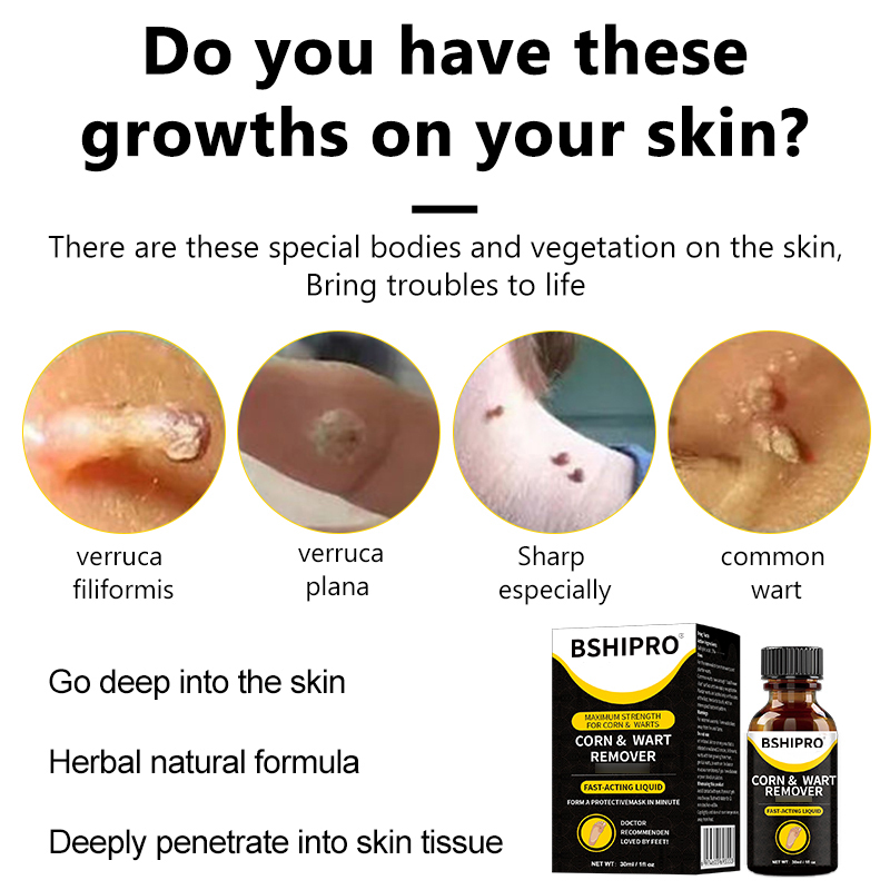 Plantar Wart Corn Freeze Off Fast-Acting Wart Remover Liquid Salicylic Acid Wart Remover