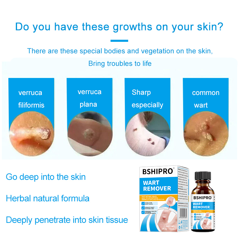 Safe Formula Fast Acting and Effective Common and Plantar Wart Remover Liquid 30ml for Repair Body Skin