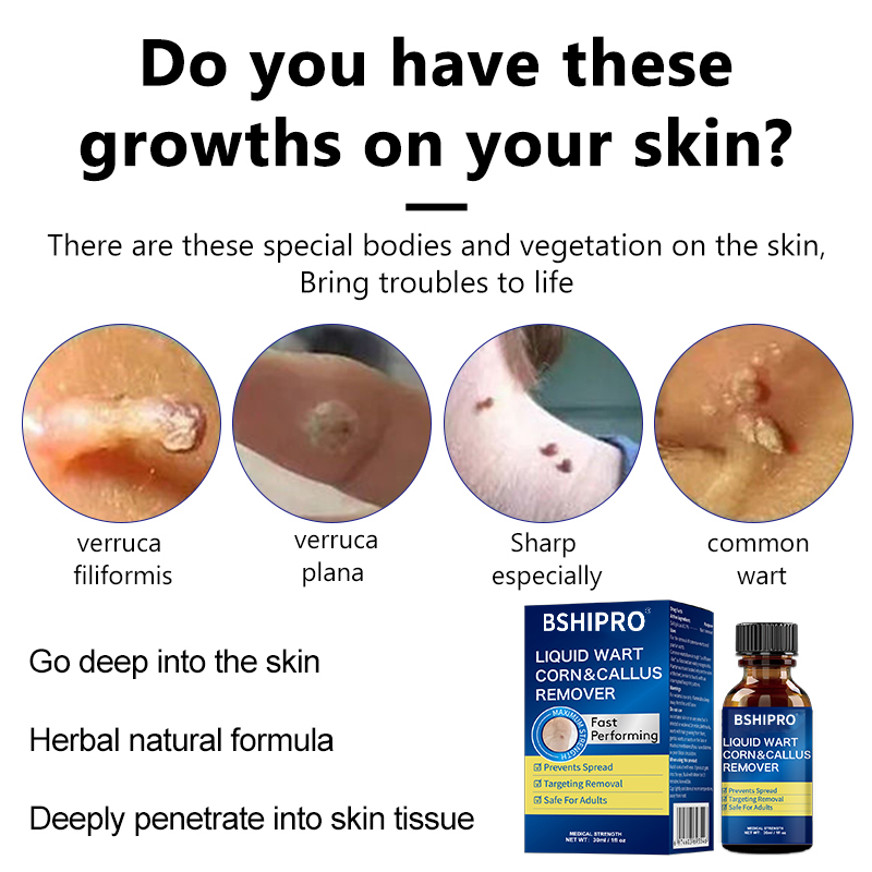 Salicylic Acid Fasting Performing Effective and Safe Wart Corn Callus Remover Liquid
