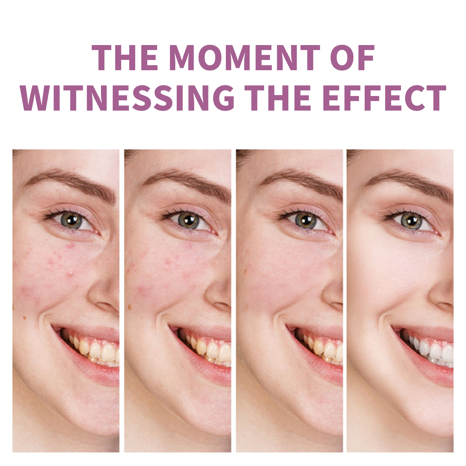 Fasting Acting Acne Removal Cream for Clearing and Preventing Blemishes & Clogged Pores