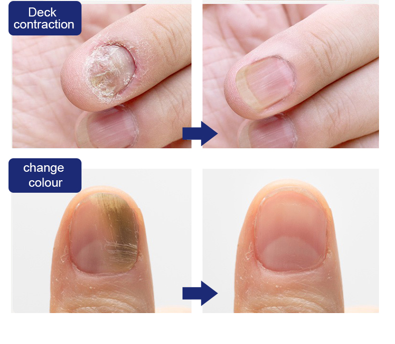 Fast Acting Herbal Formula Safe and Effective 30ml Fugal Nail Renewal Liquid 