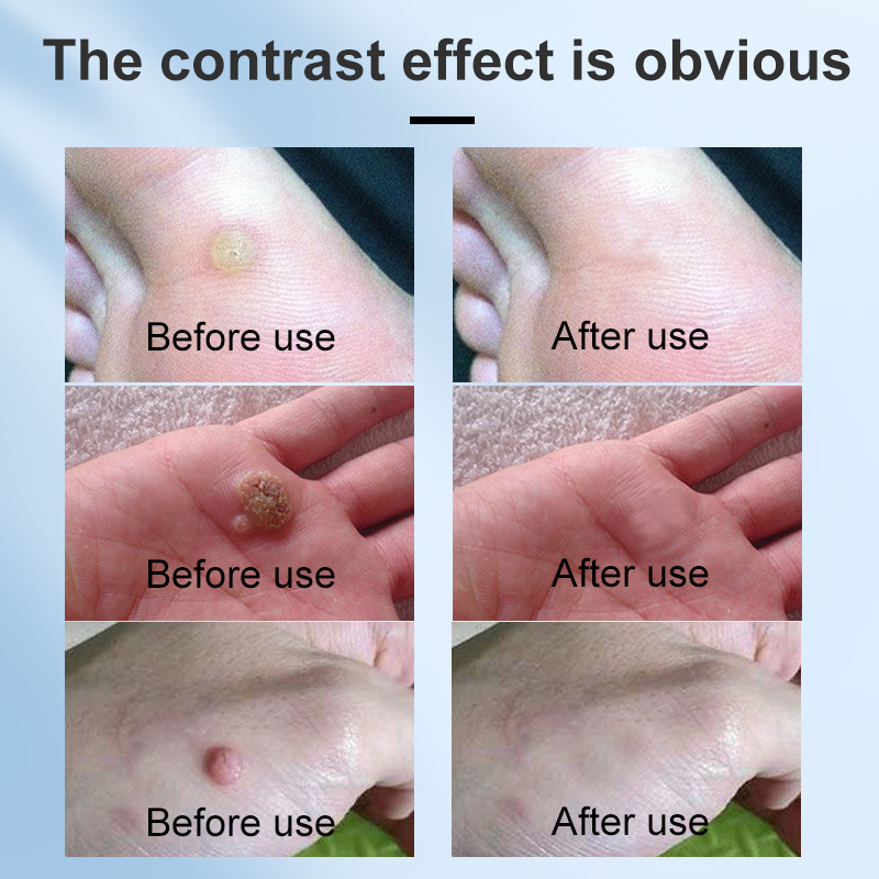Salicylic Acid Fasting Performing Effective and Safe Wart Corn Callus Remover Liquid