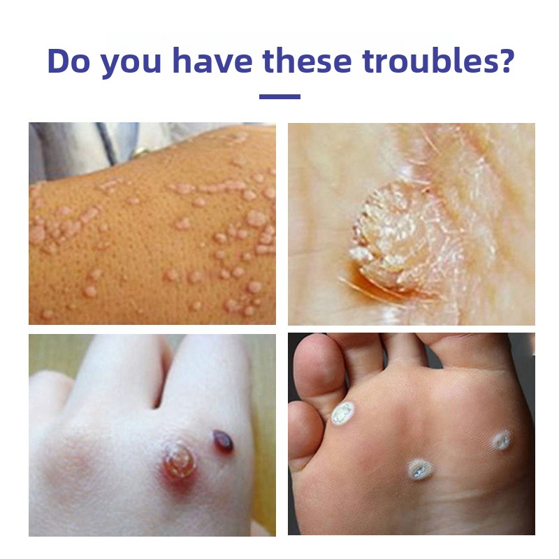 Herbal Plant Essence Extract for Wart Removal Effective Solution for Foot Flesh Balls Crossed Warts