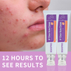 Fasting Acting Acne Removal Cream for Clearing and Preventing Blemishes & Clogged Pores