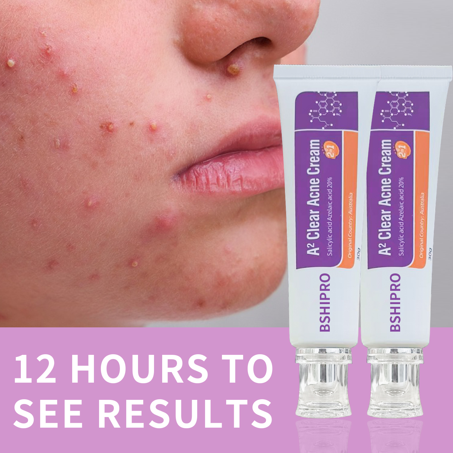 Fasting Acting Acne Removal Cream for Clearing and Preventing Blemishes & Clogged Pores