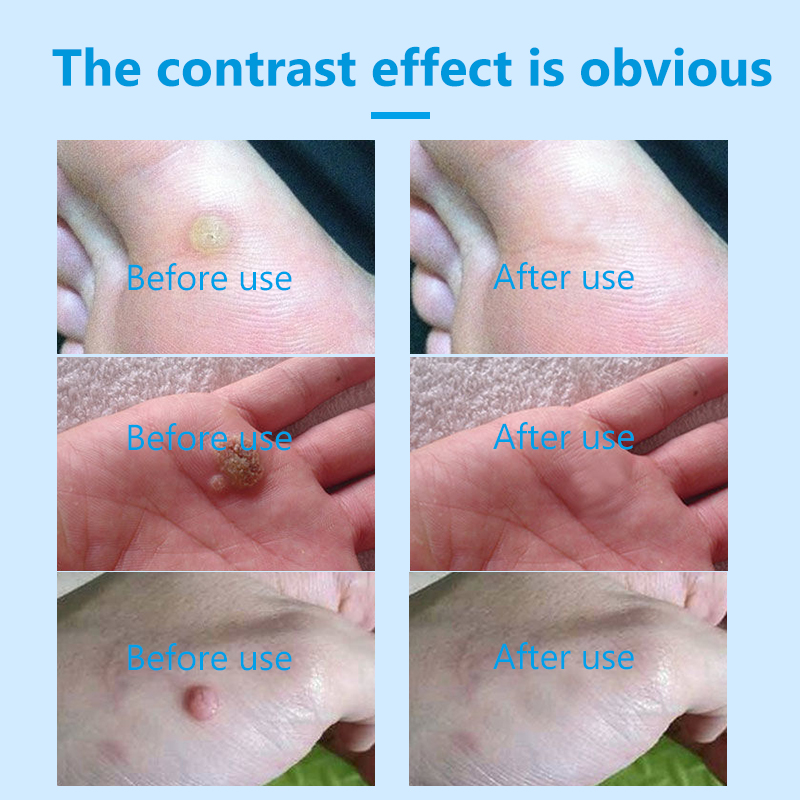 Fast-Acting Plantar Wart Genital Wart Corns Calluses Wart Corn Callus Remover Liquid