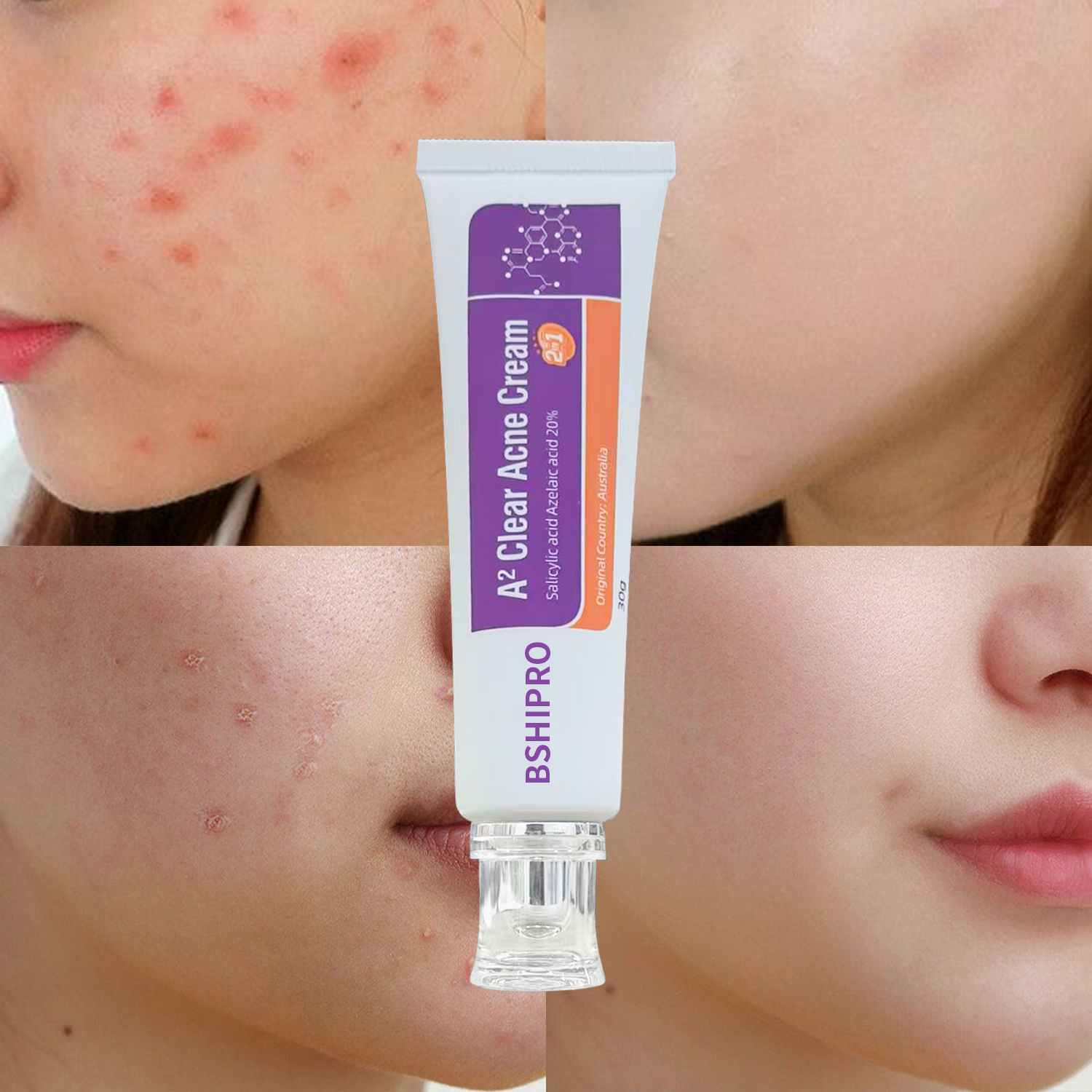 Fasting Acting Acne Removal Cream for Clearing and Preventing Blemishes & Clogged Pores