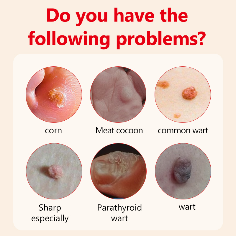 Sharp Wart Liquid Natural Ingredients Rapid Wart and Corn Removal 40% Salicylic Acid Tag Wart Remover Pads