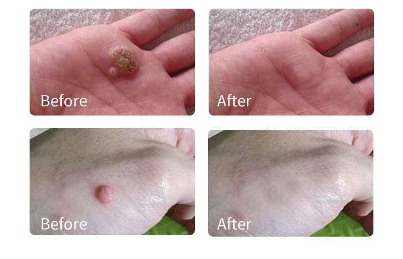 Sharp Wart Liquid Natural Ingredients Rapid Wart and Corn Removal 40% Salicylic Acid Tag Wart Remover Pads