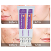 Fasting Acting Acne Removal Cream for Clearing and Preventing Blemishes & Clogged Pores