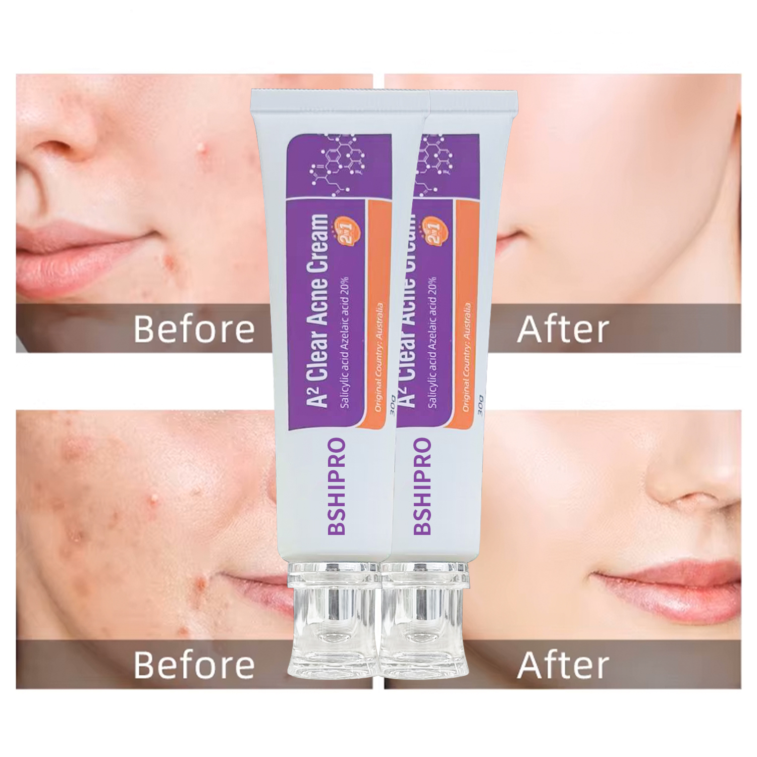 Fasting Acting Acne Removal Cream for Clearing and Preventing Blemishes & Clogged Pores
